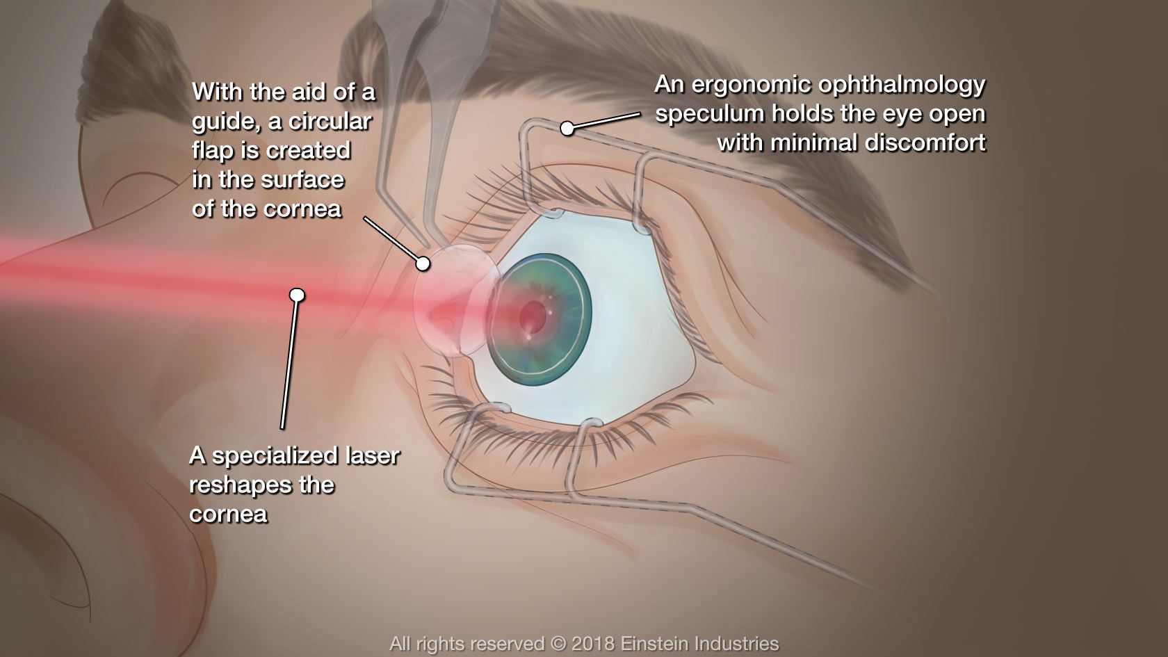 Diagram of LASIK procedure